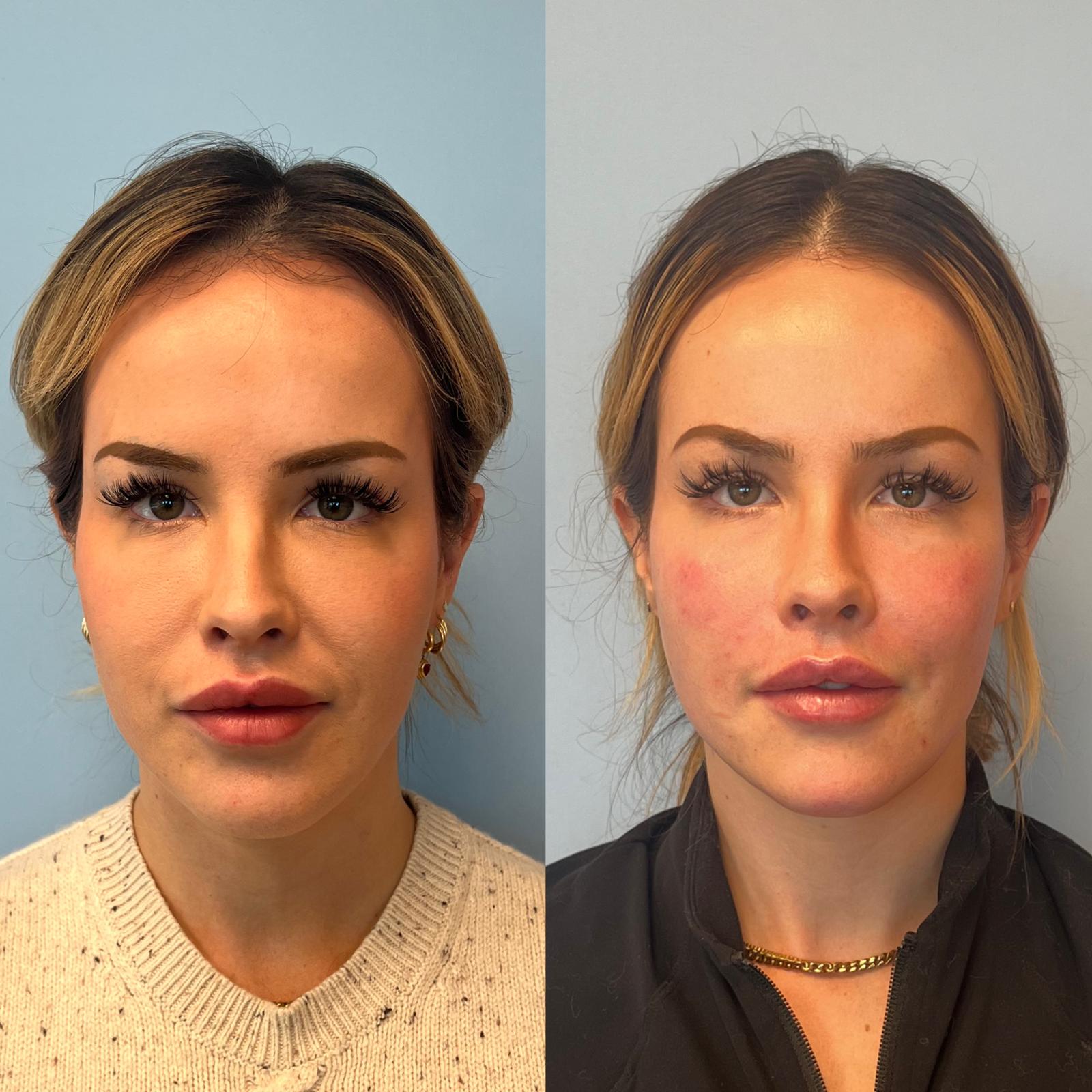 Before and after Full Face & Lip Dissolve and Refill at Aster Aesthetics Salem Oregon