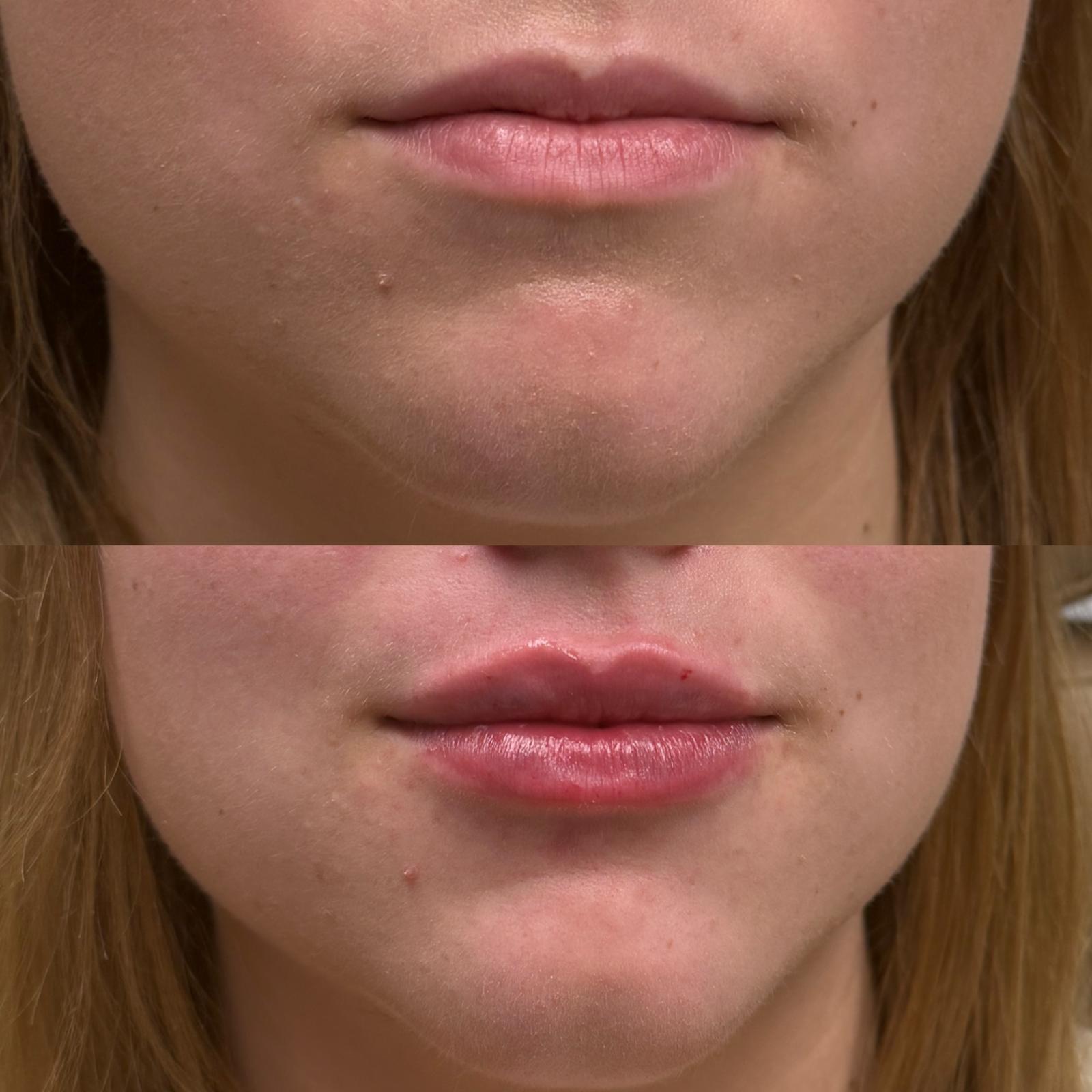Before and after Lip Enhancement at Aster Aesthetics Salem Oregon