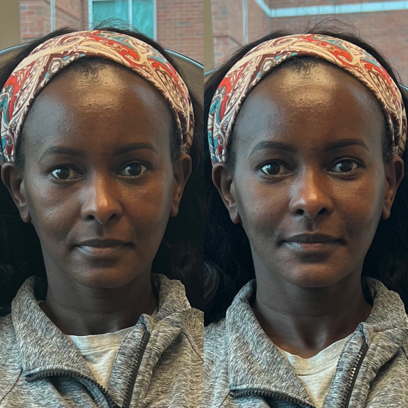 Before and after Cheek Filler at Aster Aesthetics Salem Oregon