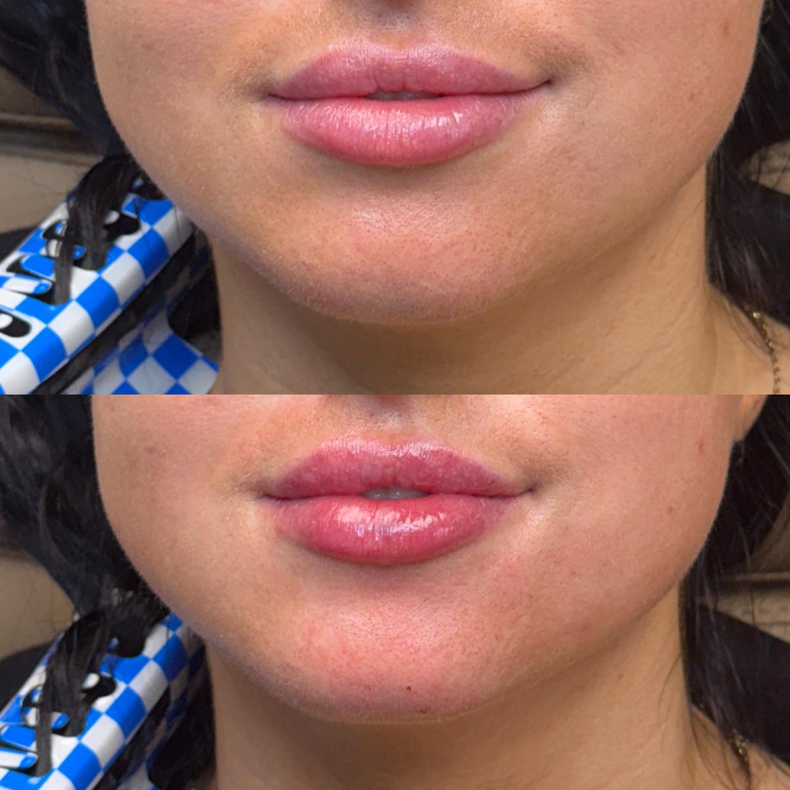 Before and after Dissolve & Refill at Aster Aesthetics Salem Oregon