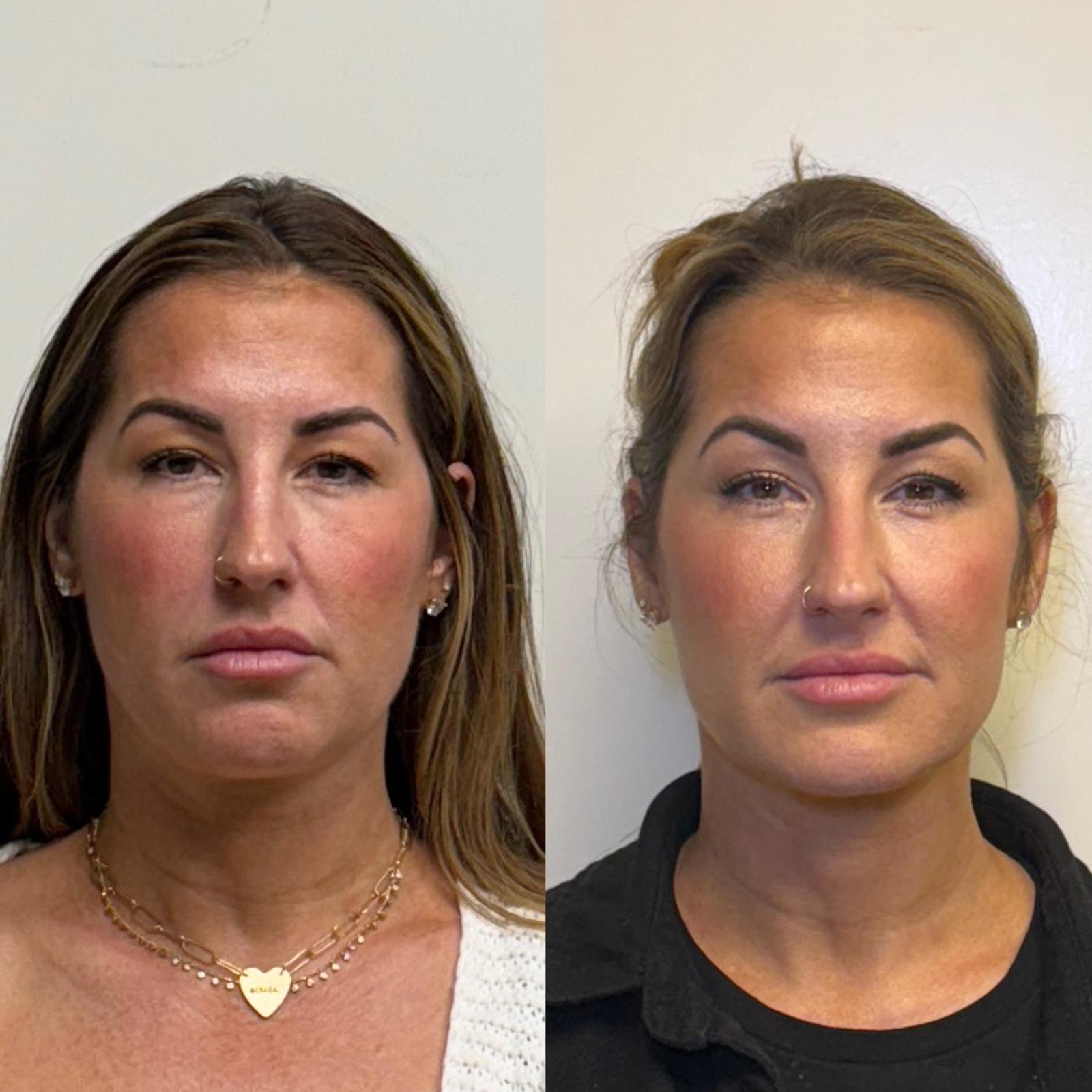 Before and after Facial Balancing at Aster Aesthetics Salem Oregon