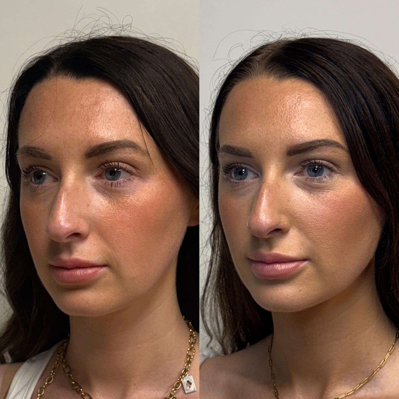 Before and after Facial Balancing — Healed Results at Aster Aesthetics Salem Oregon