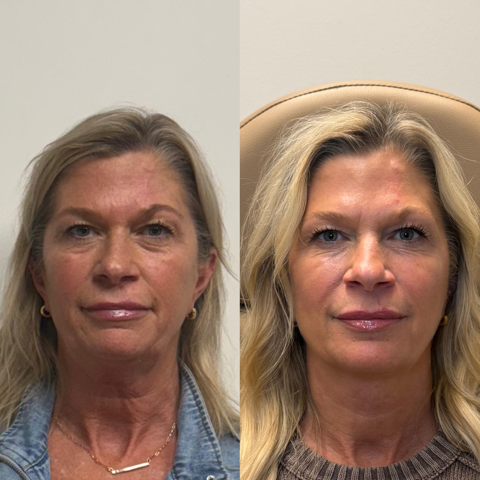 Before and after Facial Balancing — Healed Results at Aster Aesthetics Salem Oregon