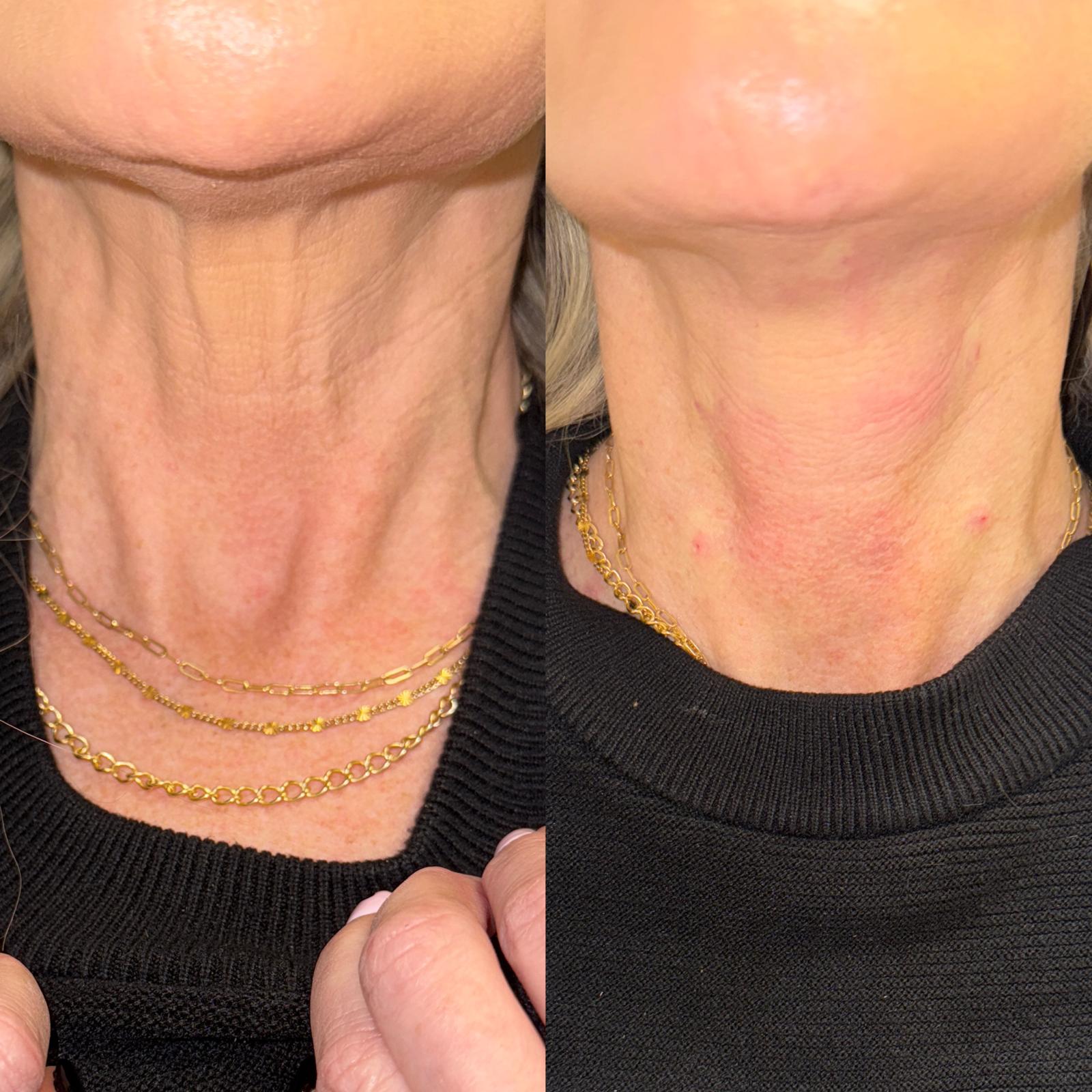 Before and after Hyperdilute Radiesse Neck Treatment at Aster Aesthetics Salem Oregon