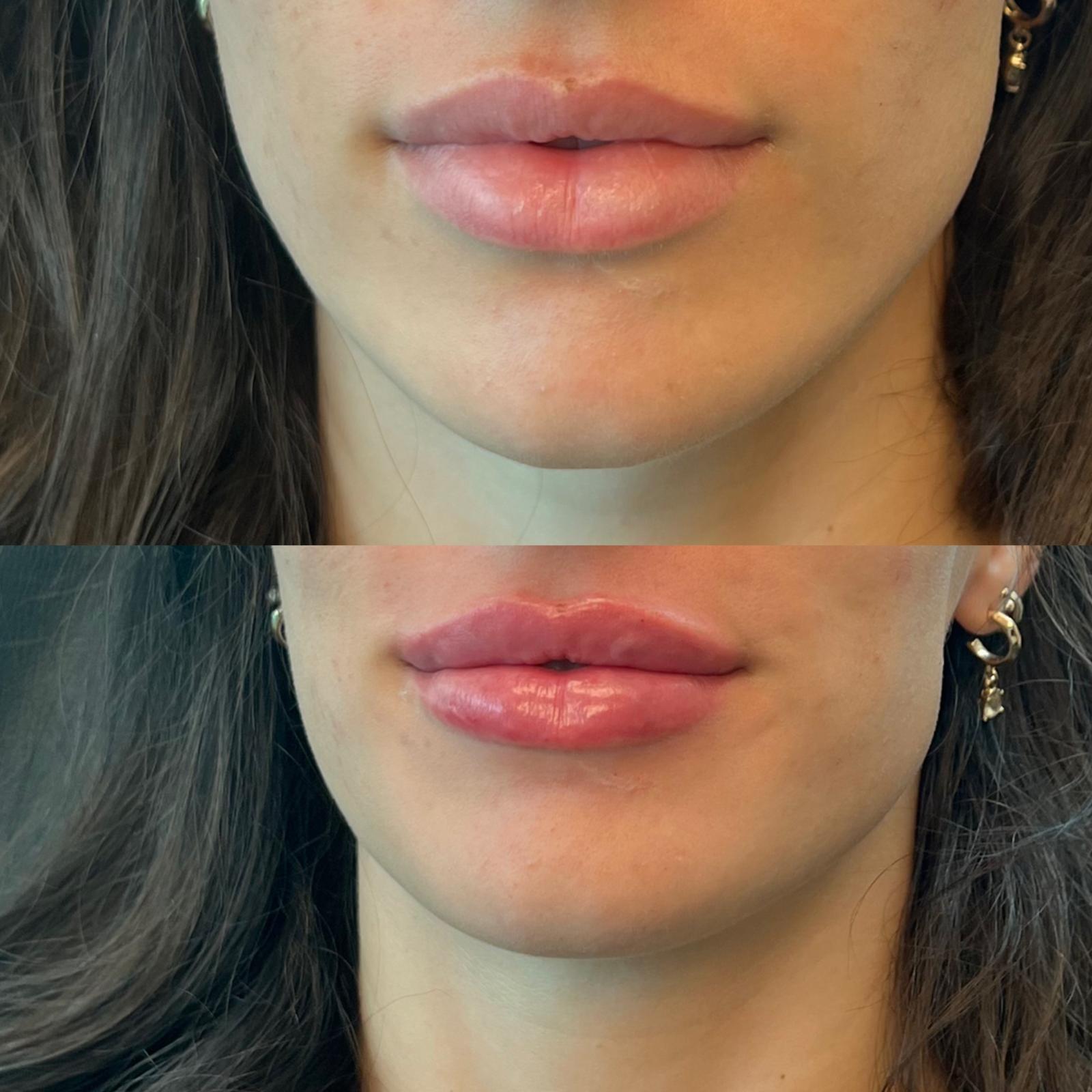 Before and after Lip Filler at Aster Aesthetics Salem Oregon