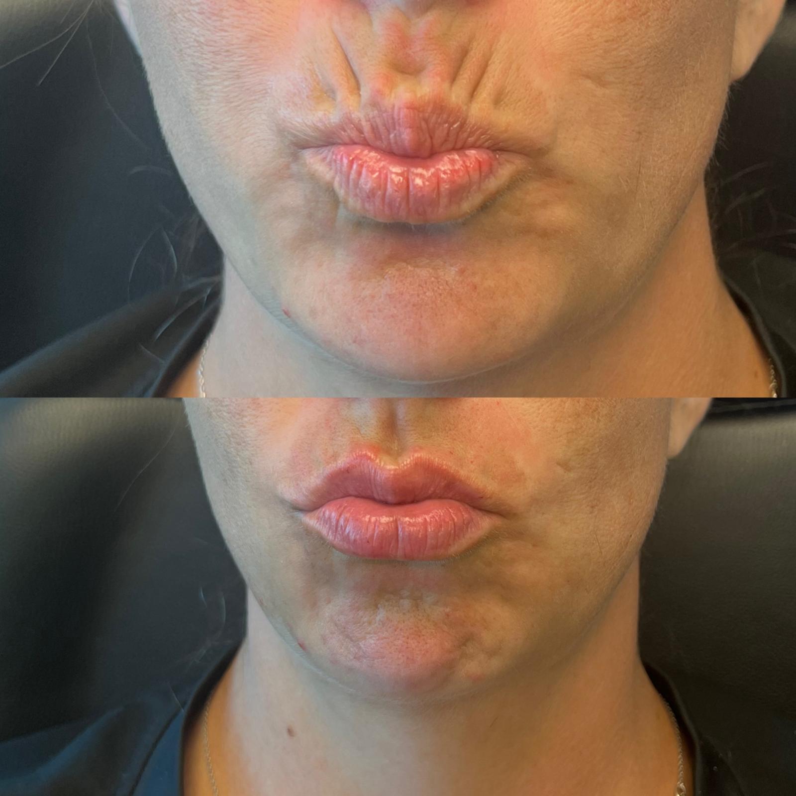 Before and after Lip Filler — Before & Immediately After at Aster Aesthetics Salem Oregon