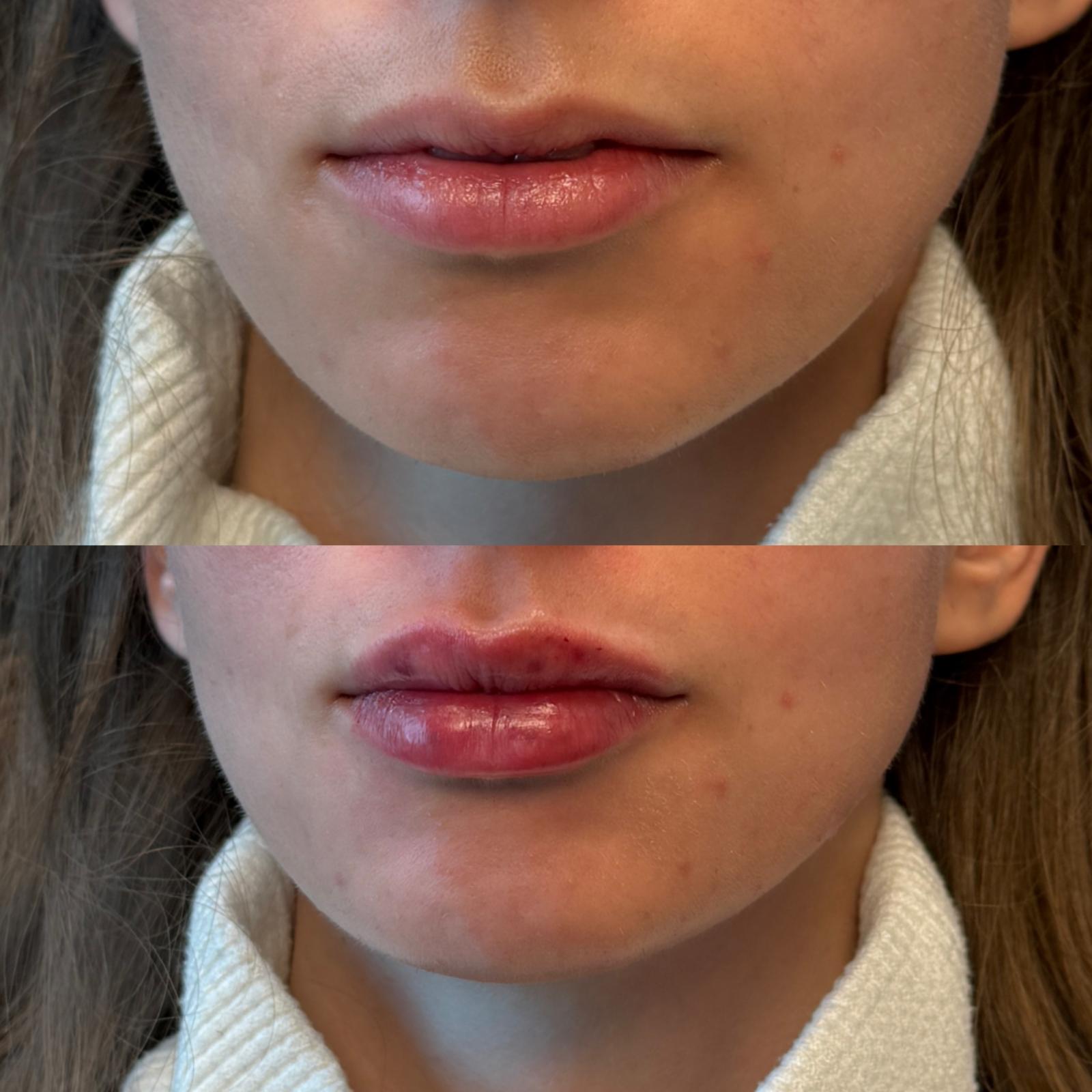 Before and after M-Shape Lip Correction at Aster Aesthetics Salem Oregon